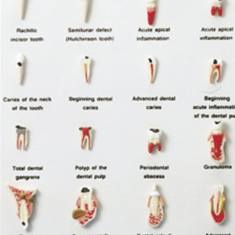 مدل-بیماری-های-دندان