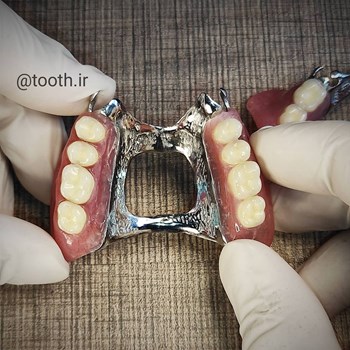 پروتز-پارسیل-متحرک-دندانسازی-لبخند-بندرعباس