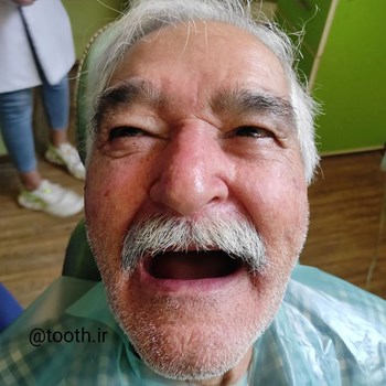 نمونه-پروتز-دندانیدندان-مصنوعیدنداسازی-لبخند-بندرعباس