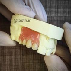 نمونه-دیگر-از-پروتز-دندان-فلیپر-لابراتوار-دندانسازی-لبخند-بندرعباس