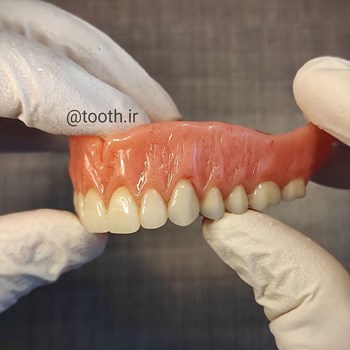 نمونه-پروتز-دندانیدندان-مصنوعیدنداسازی-لبخند-بندرعباس