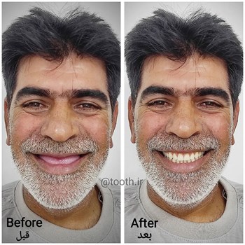 Befor-After-پروتز-دنداندندان-مصنوعیدندانسازی-لبخند-بندرعباس