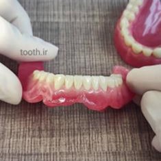 نمونه-ای-از-پروتز-های-دندانی-دندانسازی-لبخند-بندرعباس