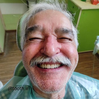 نمونه-پروتز-دندانیدندان-مصنوعیدنداسازی-لبخند-بندرعباس
