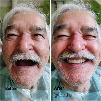 نمونه-پروتز-دندانیدندان-مصنوعیدنداسازی-لبخند-بندرعباس