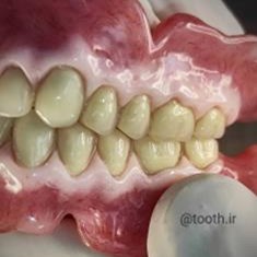 پروتز-کامل-دندان-دندانسازی-لبخند-بندرعباس