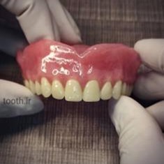 پروتز-های-دندانیدندان-مصنوعیدندانسازی-لبخند-بندر-عباس