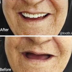 Befor-After-پروتز-دنداندندان-مصنوعیدندانسازی-لبخند-بندرعباس