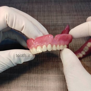 پروتز-های-دندانی-دندانسازی-لبخند-بندرعباس