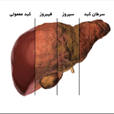 درمان-کبد-چرب