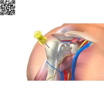 سیستم-تزریق-درون-استخوانی-EZ-IO-Arrow